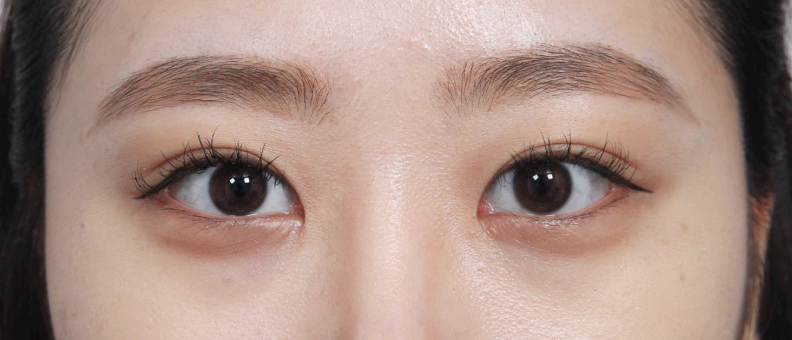 쌍꺼풀 수술과 뒷트임 밑트임 시행으로 눈이 커진 여성.