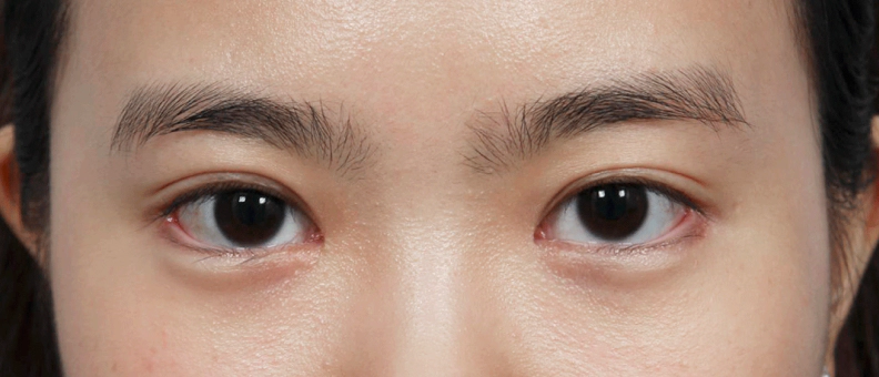 앞트임과 뒷 밑트임 눈매교정으로 눈이 커진 여성.