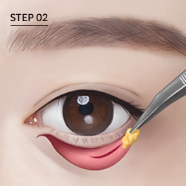 눈밑안쪽을 미세절개하여 지방을 제거 또는 재배치.