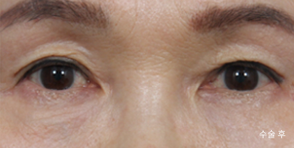 눈밑 주머니를 하안검 수술로 매끈하게 만들어 젊어보이는 여성.