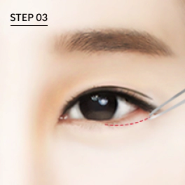 하안검 미세봉합으로 자연스러운 눈매로 개선.