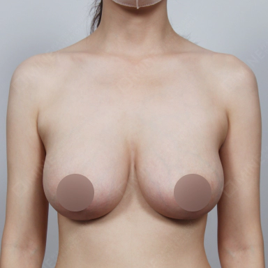 처진가슴 가슴성형 수술후 풍만하고 균형있는 가슴을 얻은 여성.