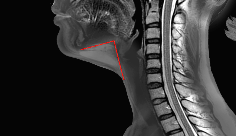 MRI사진상 이중턱 근육묶기로 턱살이 들어가는 범위.