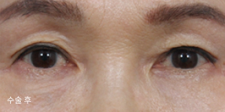 하안검 수술로 눈 밑 주름개선과 다클서클이 사라진 여성.
