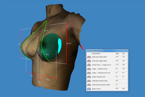 가슴 성형시 참고로 할수 있는 3D 가슴 스캔.