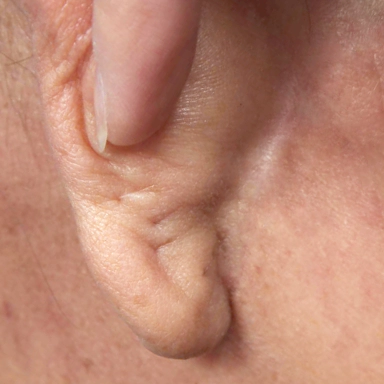 귀뒤쪽의 안면거상 수술후 3개월지난 수술 자국.