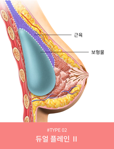처진가슴 수술 중 가슴성형의 처진 가슴에 적용하는 이중평면 듀얼 플레인2.