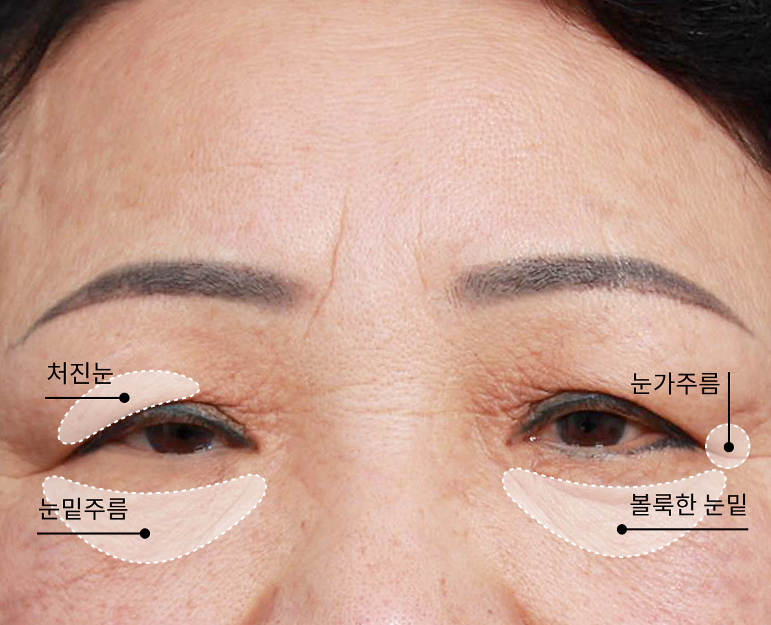 중년이 되어 나이들어보이는 부분인 쳐진눈과 눈가 주름, 눈밑주름을 가진 중년 여성의 얼굴.