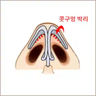 흉터 없고 대칭적인 코 성형을 위한 콧구벙 박리 방법.