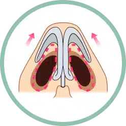 코 날개 연골을 조절하여 코구멍 모양을 만들어 주는 방향.
