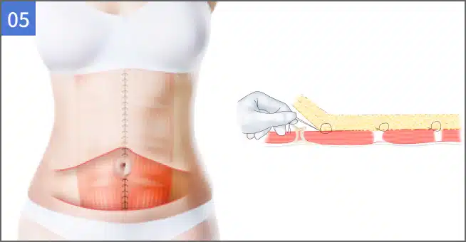 복부성형의 중요한 부분으로 progressive tension sutures 를 이용해 부작용 없이 복부 봉합.
