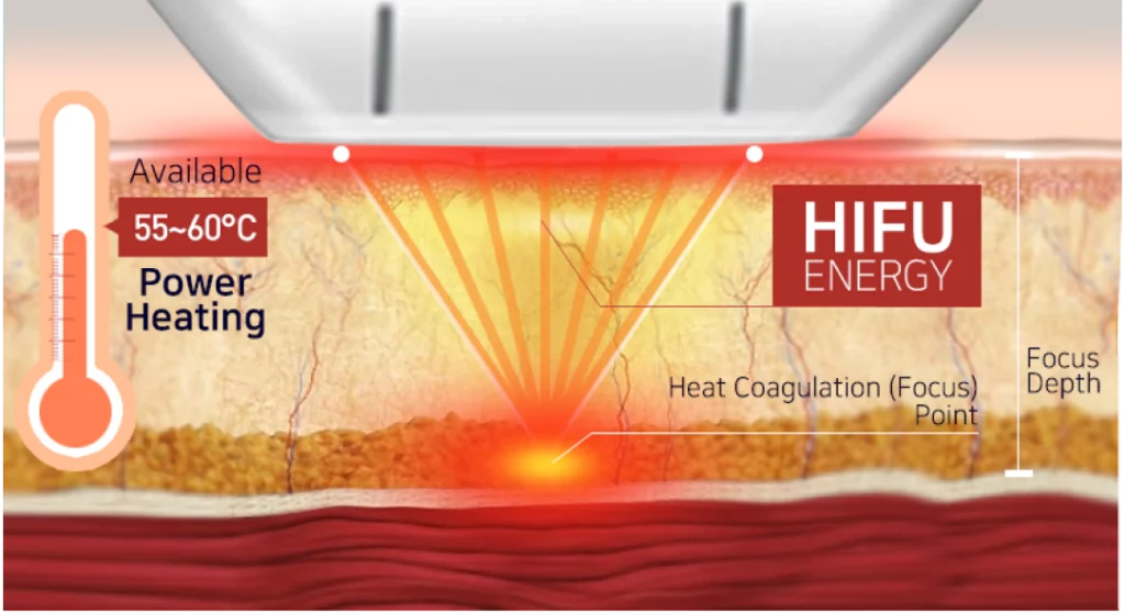 초음파 에너지(HIFU)를 이용해 진피층과 SMAS층에 각각 작용하여 피부 수축으로 리프팅 효과.
