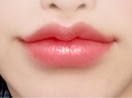 보톡스와 입술 필러 시술로 올라간 입꼬리와 볼륨있는 입술.