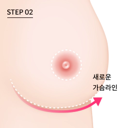 가슴축소 수술 하는 방법중 가슴밑선 절개.
