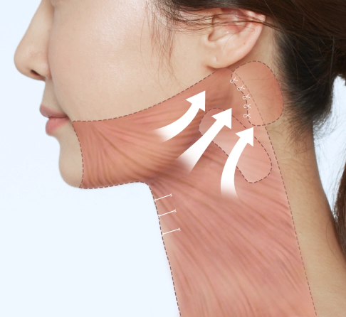 목근육인 활경근을 당겨 턱을 감싸줘 시행하는 목거상.