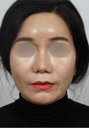 얼굴 주름개선을 위해 거상수술을 받은 중년 여성.