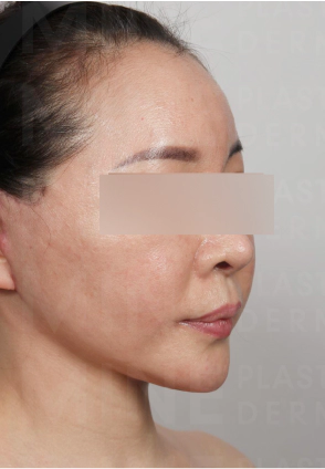 얼굴과 목주름이 심해 안면거상과 목거상을 동시에 시행받은 여성.