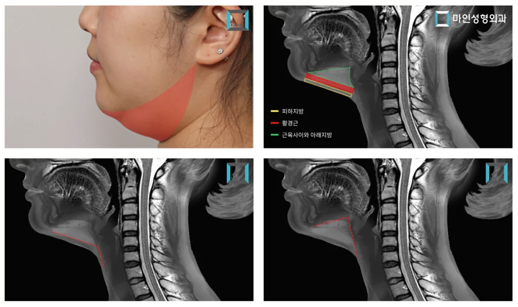 이중턱을 가진 여성에서 턱살 지방을 보여주는 MRI 사진. 근육하 지방도 보인다.
