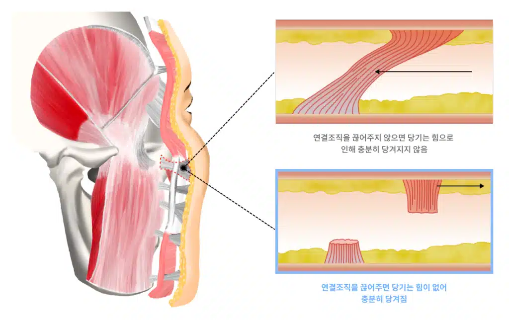 안면거상술 과정증 유지인대 박리에 대한 설명하는 이미지.