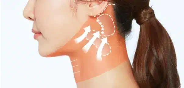 마인 미니목거상술의 과정 중 하나로 목 근육을 귀 뒤쪽에서 당겨주는 이미지. 