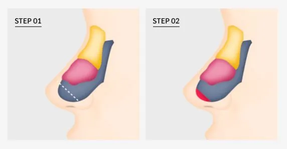 Long nose / droopy nose case for customized rhinoplasty planning