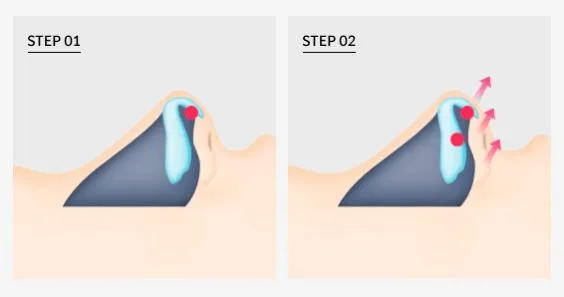 Long nose tip rotation technique used in customized rhinoplasty