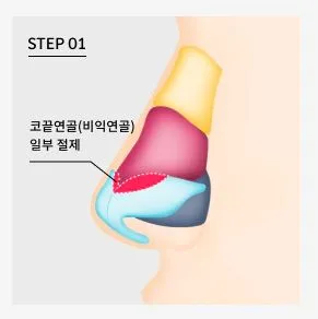 Droopy nose result after customized rhinoplasty tip correction