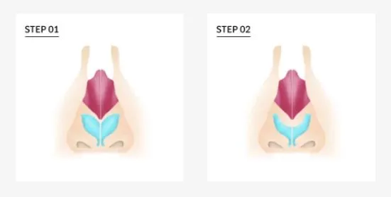 Bulbous nose assessment before customized rhinoplasty