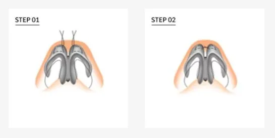 Bulbous nose cartilage reshaping during customized rhinoplasty