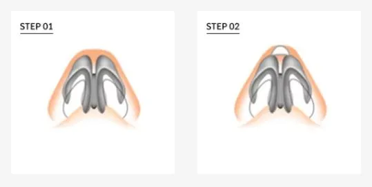 Refined nasal tip after customized rhinoplasty for bulbous nose
