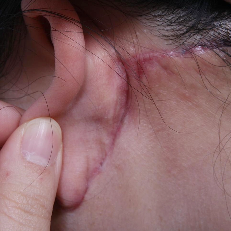 Facelift scar management for postauricular scars.
