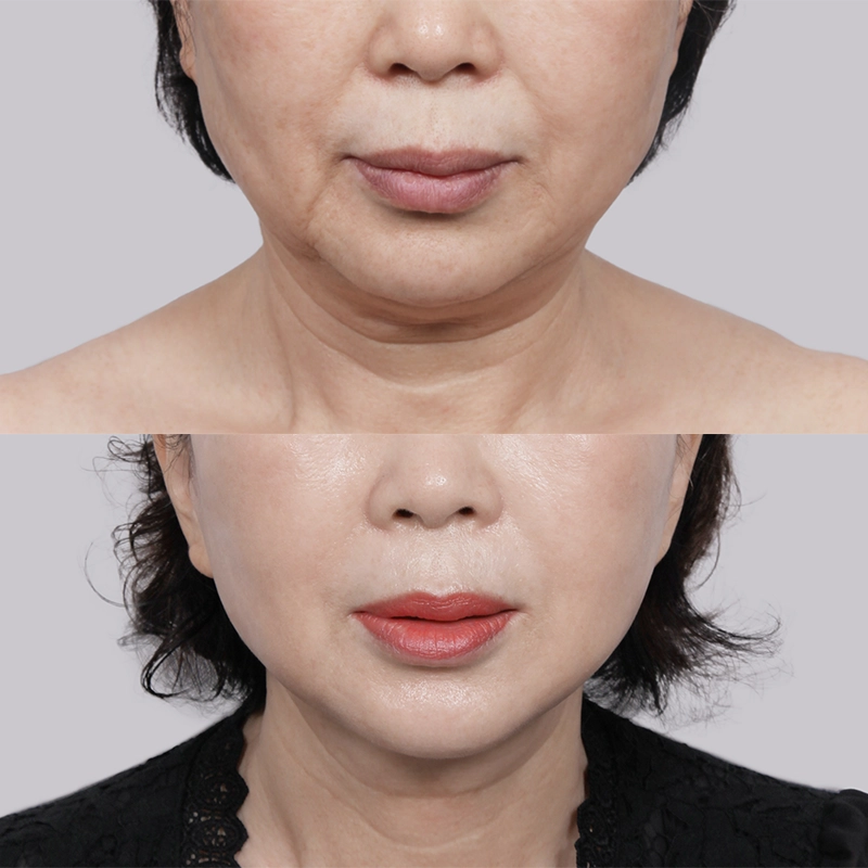 Necklift and facelift before and after results.