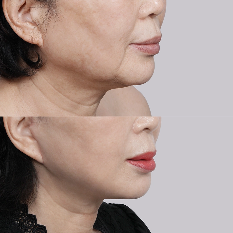 A 45 degrees view of necklift and facelift before and after results.