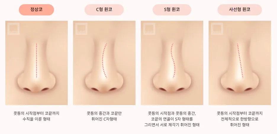 Deviated nose before correction — customized rhinoplasty example