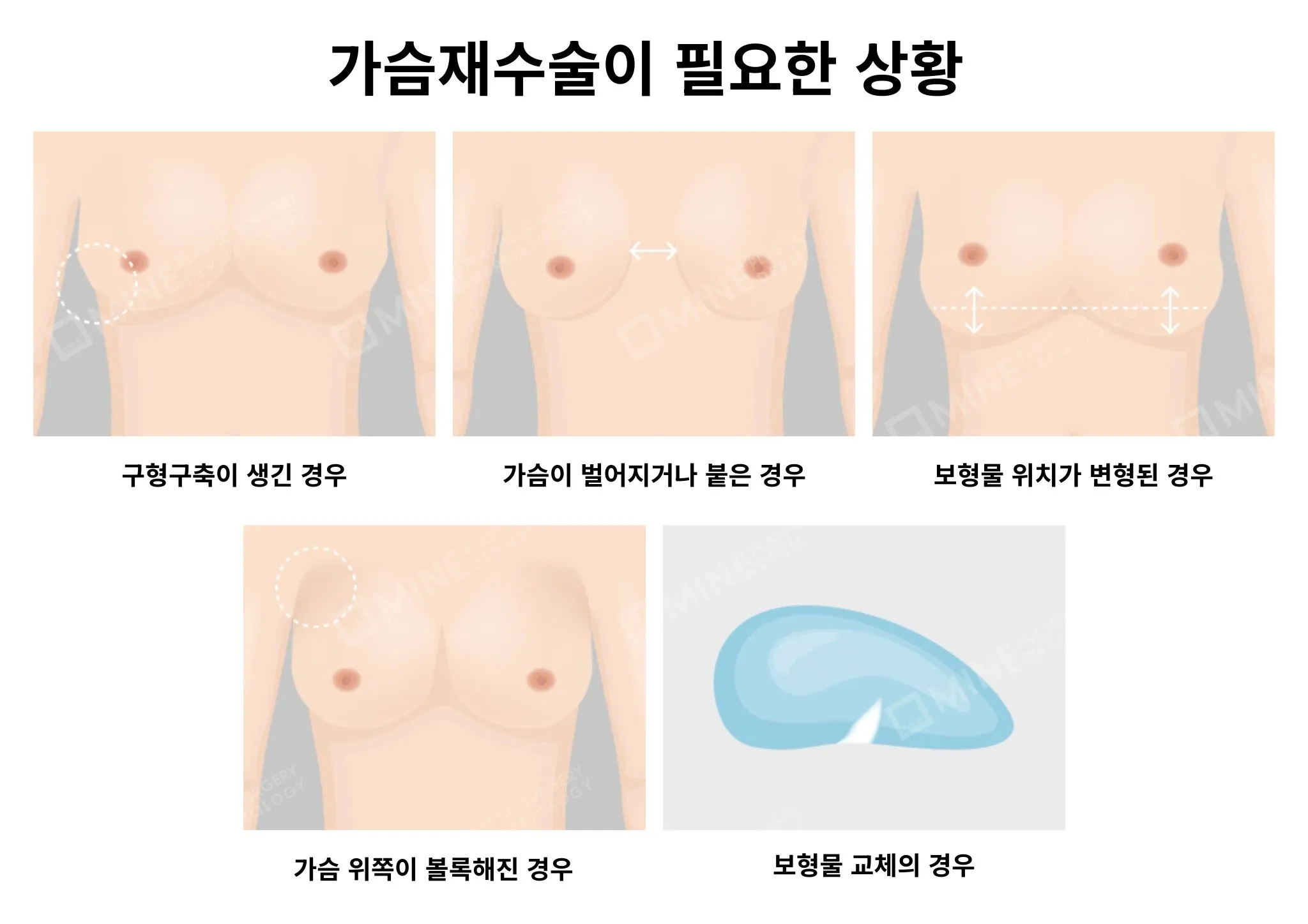 Breast revision surgery consultation with a specialist