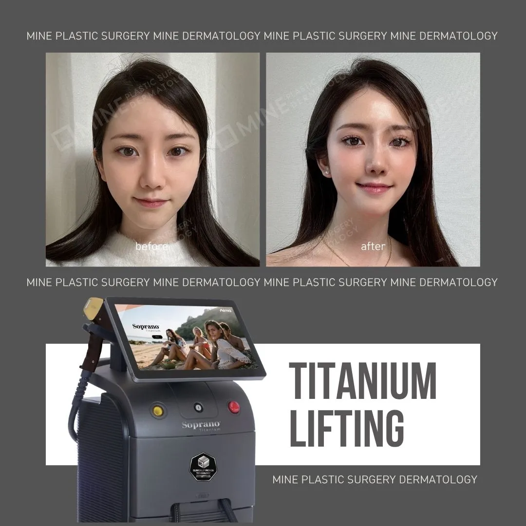 Comparison of Titanium Lifting and Thread Lifting results