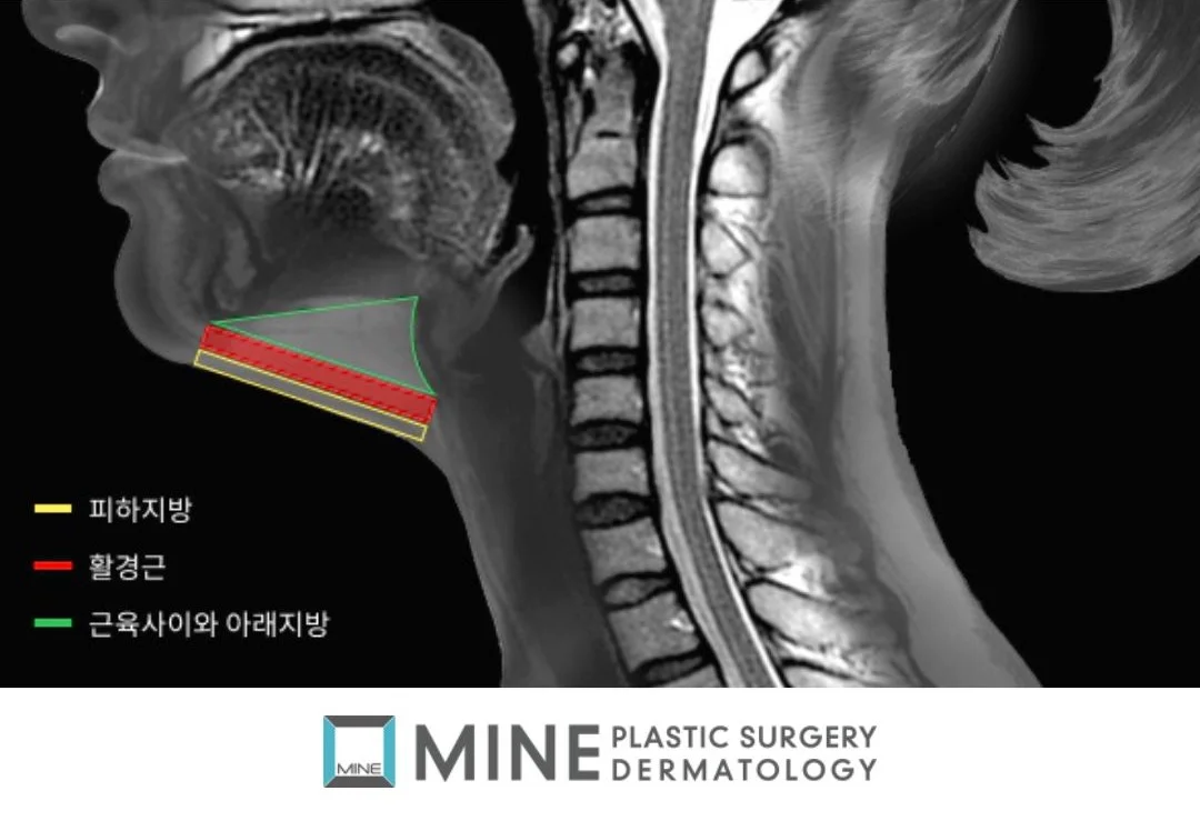 Submental MRI anatomy for double chin surgery showing platysma muscle layer, subcutaneous fat, and submandibular salivary glands relevant to double chin surgery planning.