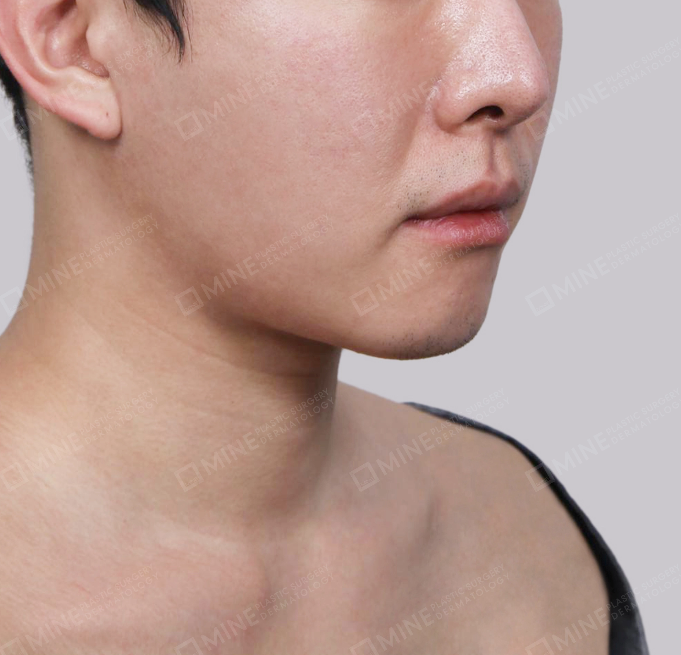 이중턱 근육묶기-전후-전