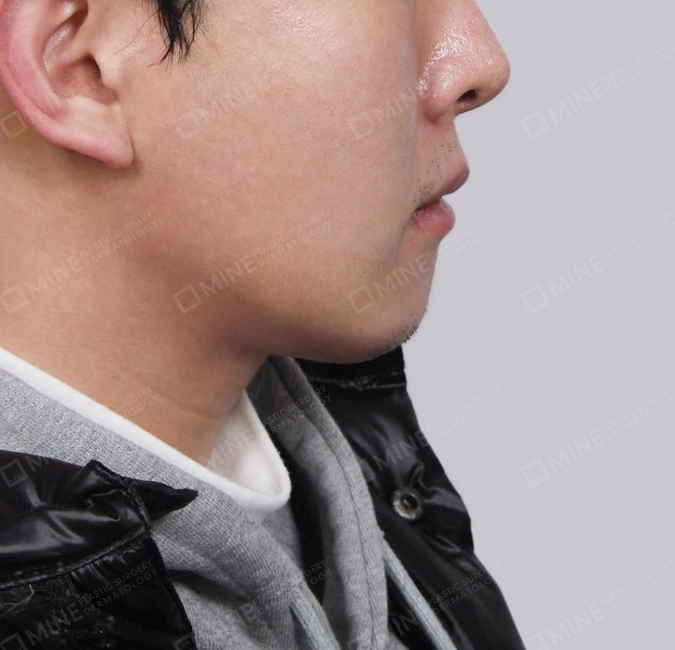 이중턱 근육묶기-측면-후