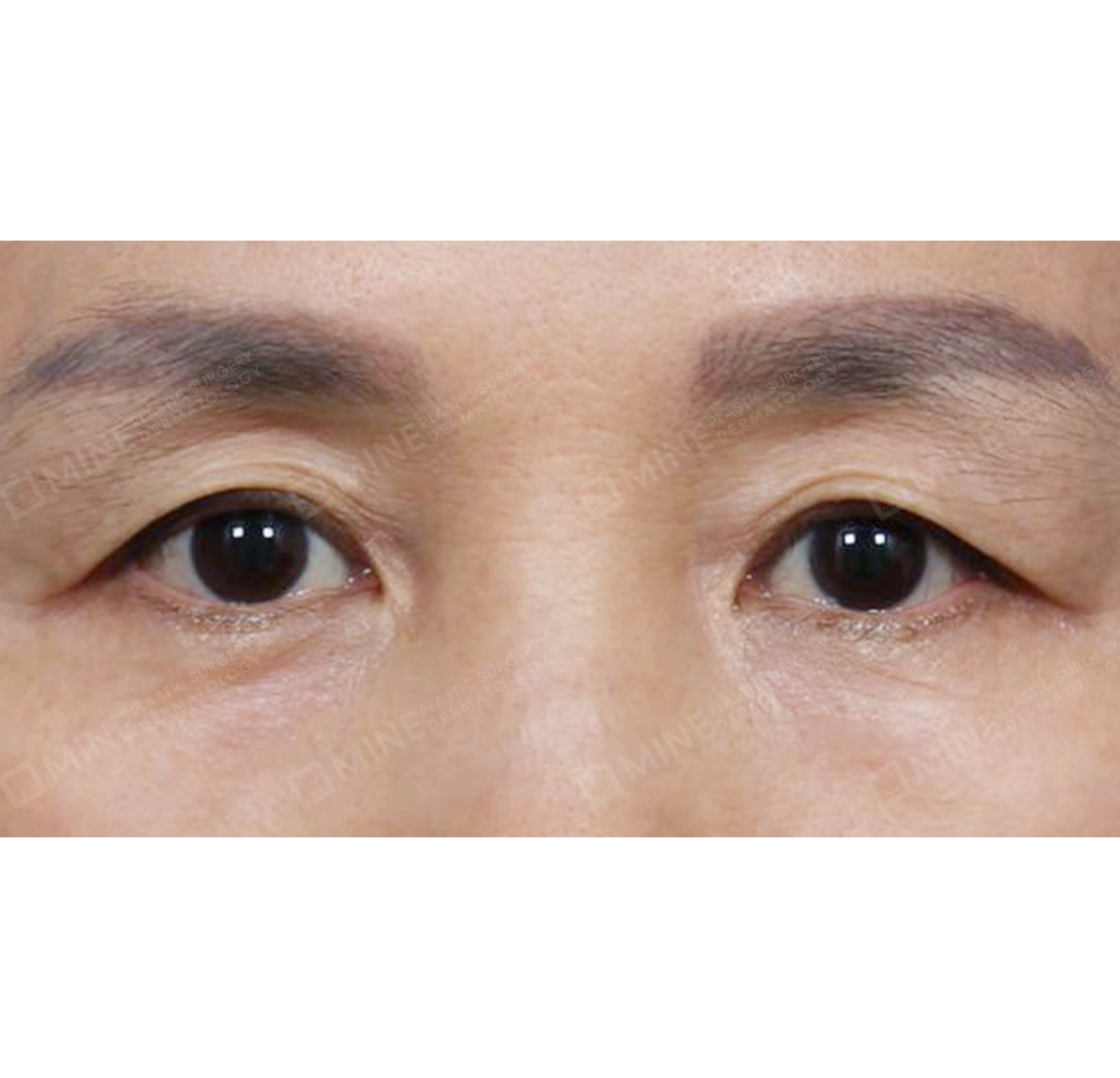 상안검 + 하안검 + 눈썹하거상-전후-전