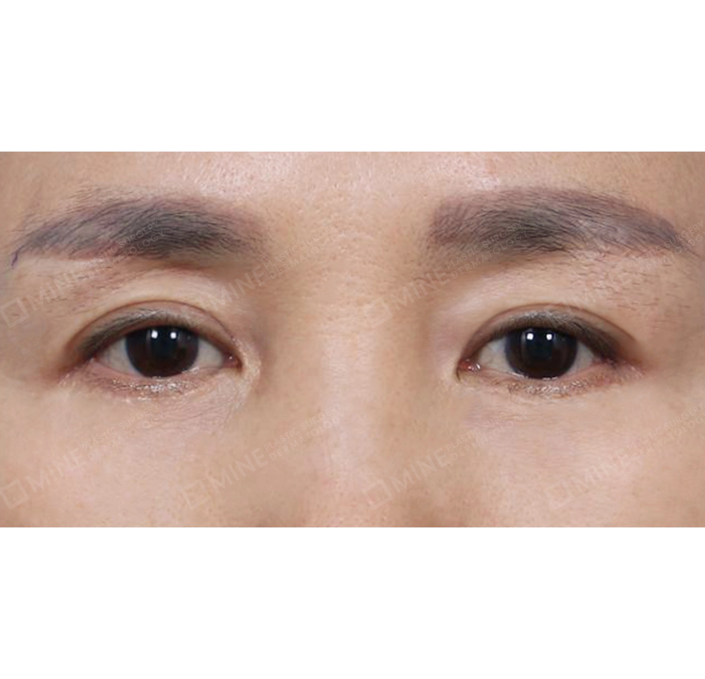 상안검 + 하안검 + 눈썹하거상-전후-후
