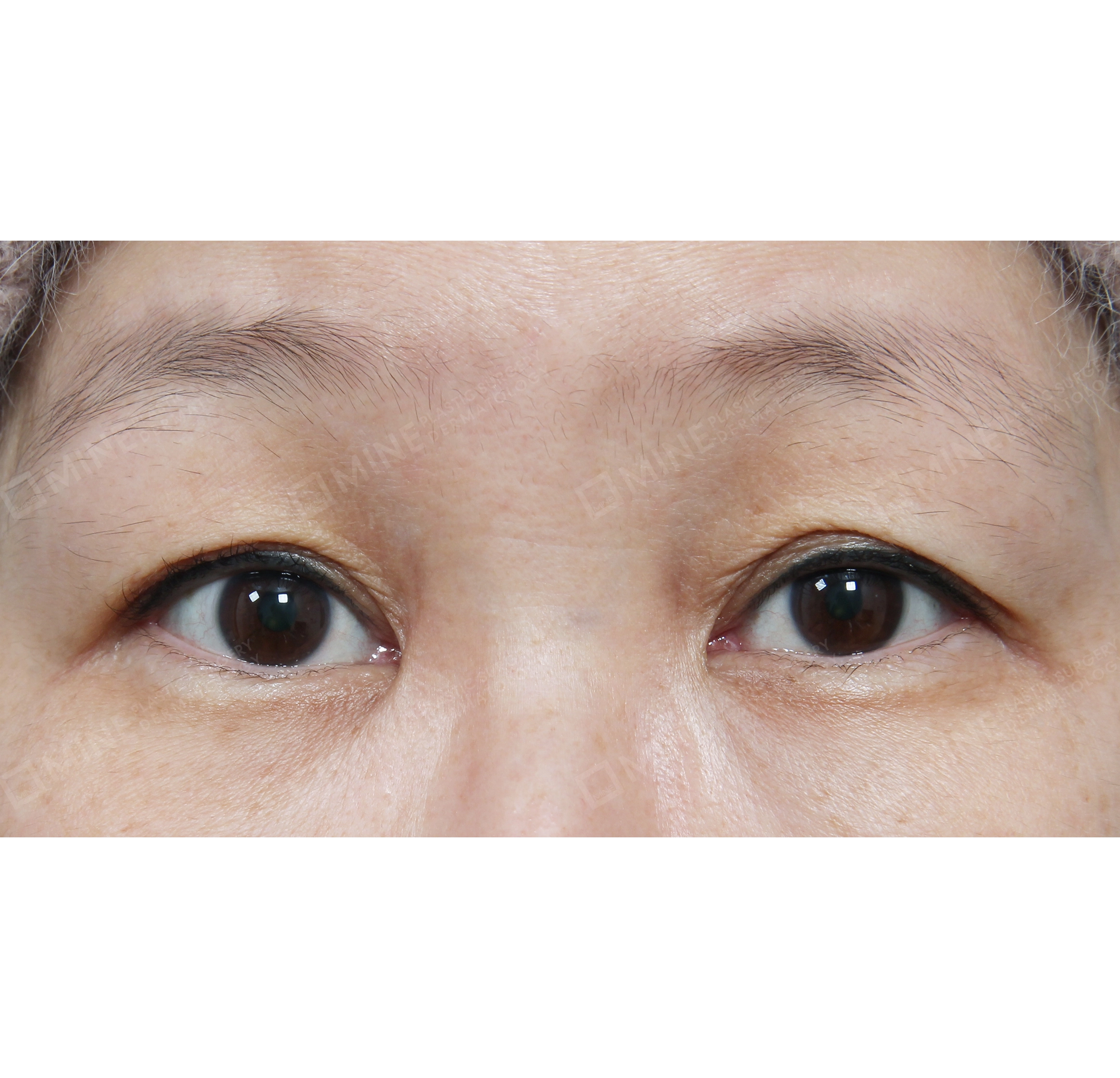 눈매교정 + 뒷밑트임-전후-전