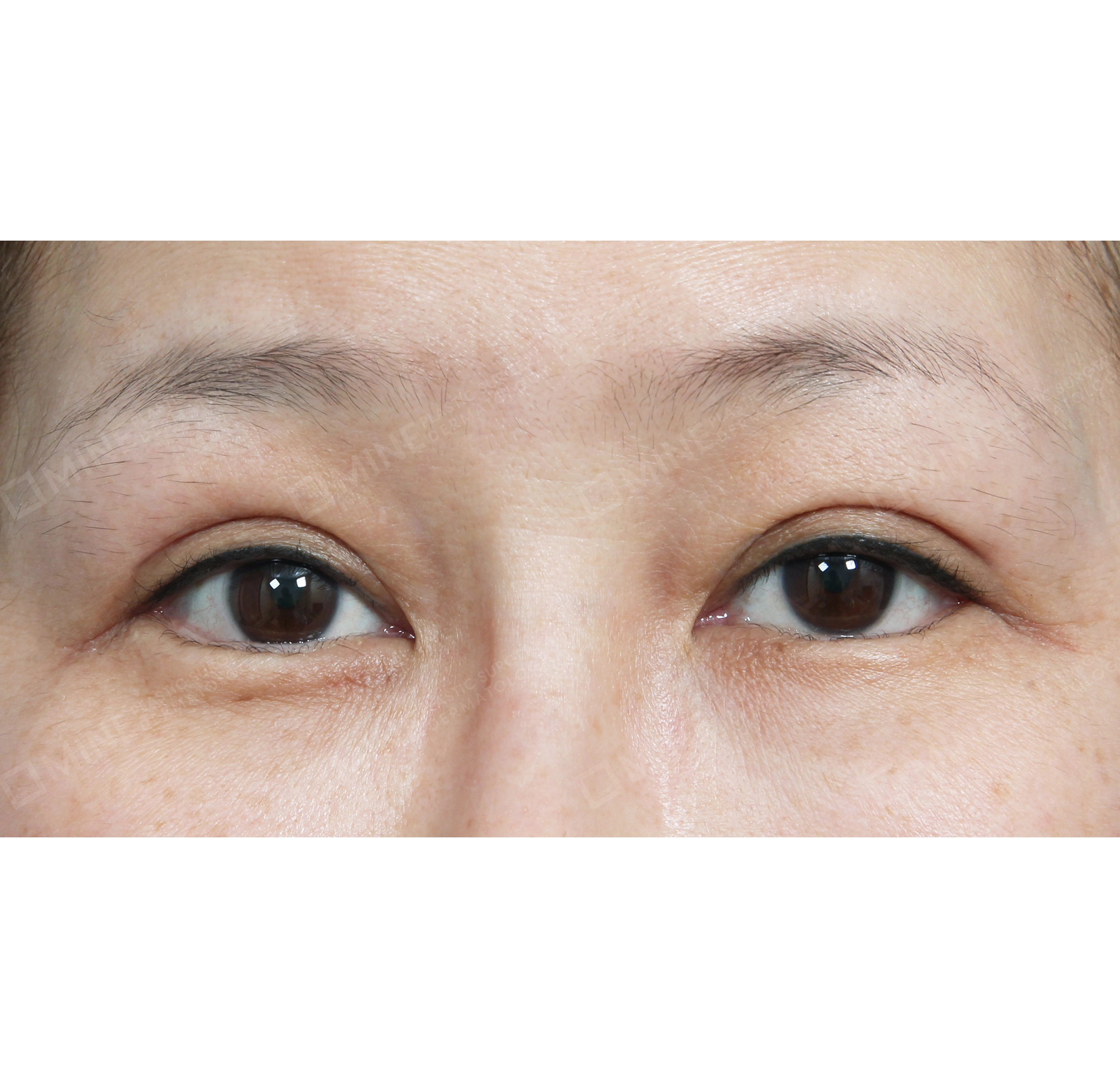 눈매교정 + 뒷밑트임-전후-후