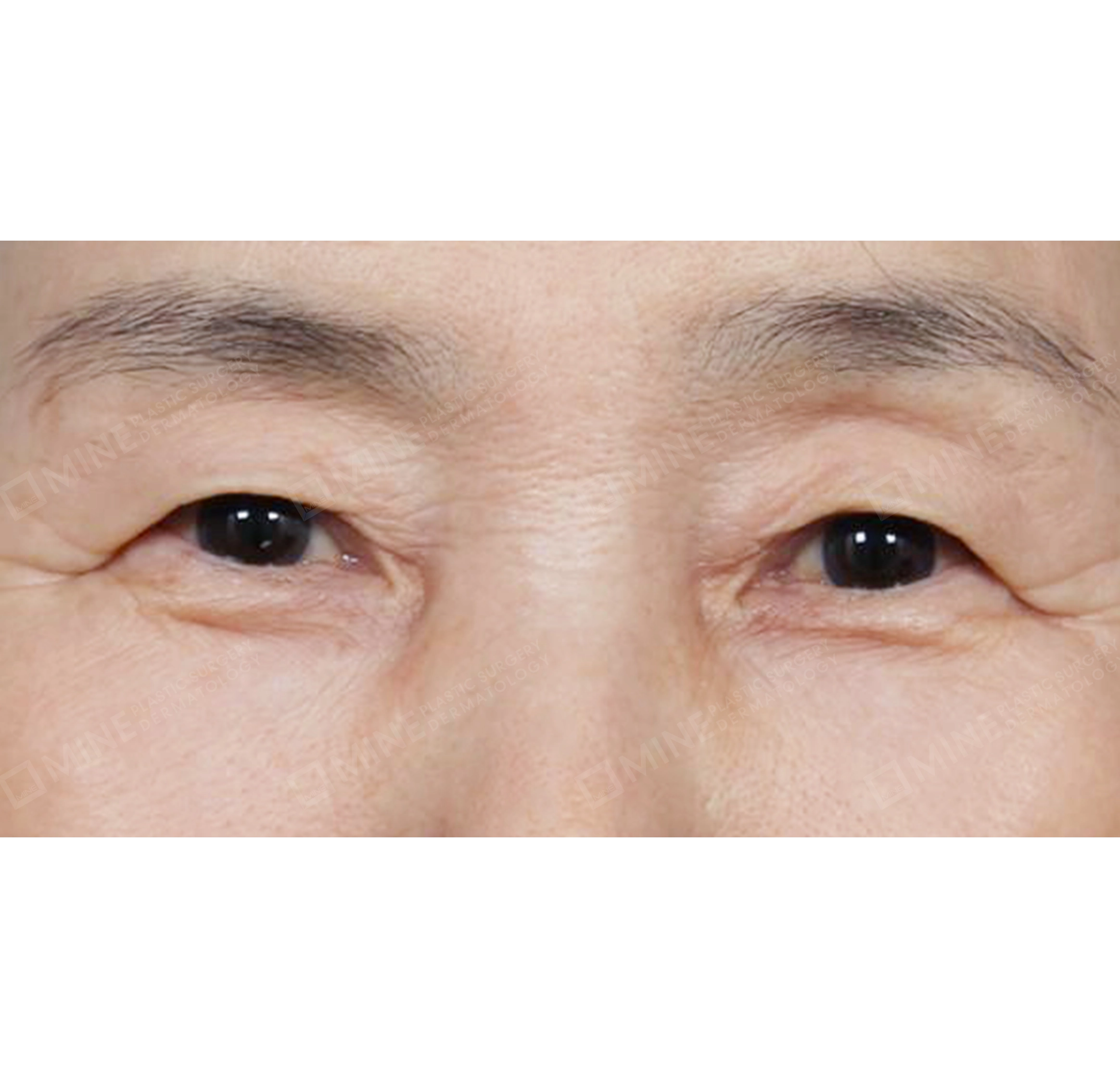 상안검 + 눈두덩이 지방재배치-전후-전