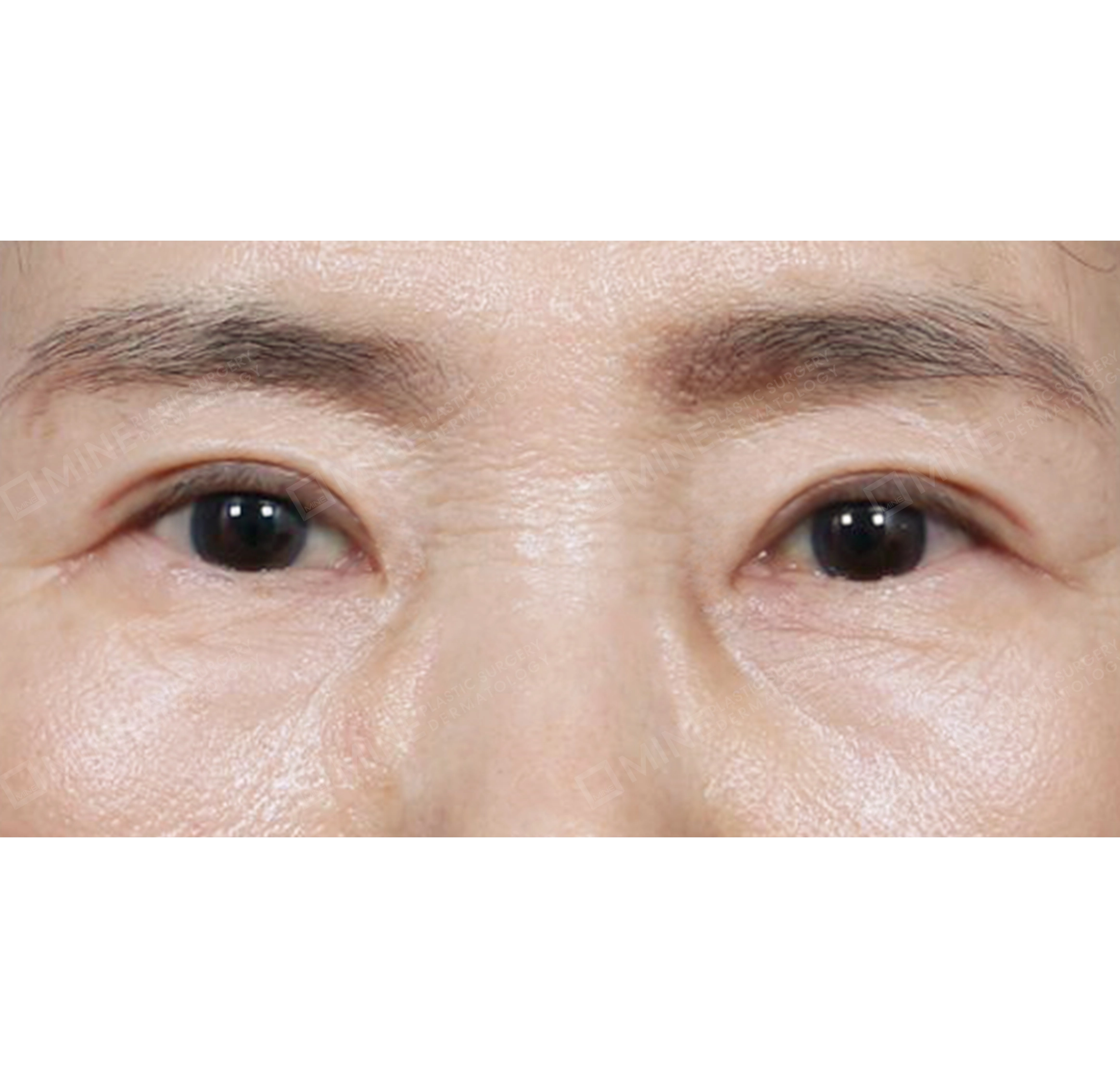 상안검 + 눈두덩이 지방재배치-전후-후