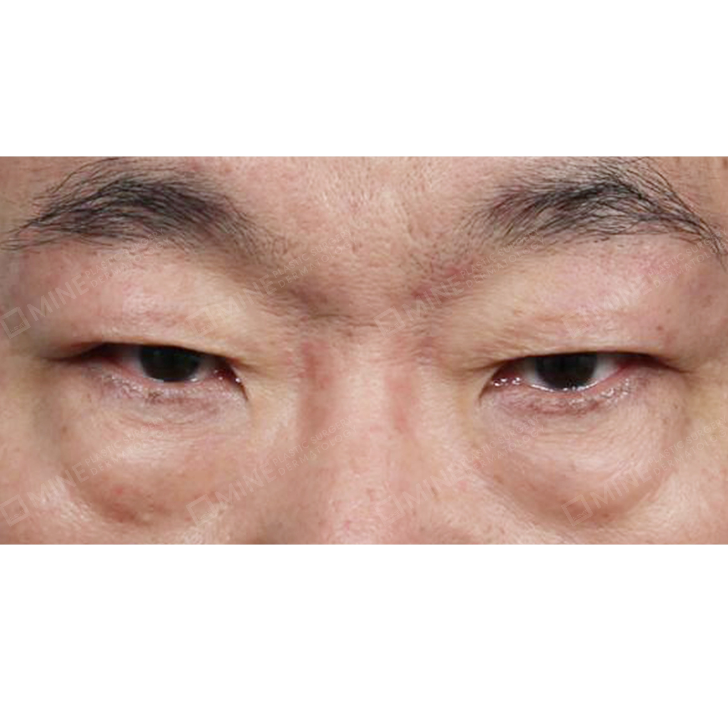 눈썹하거상 + 하안검 + 눈위지방제거-전후-전