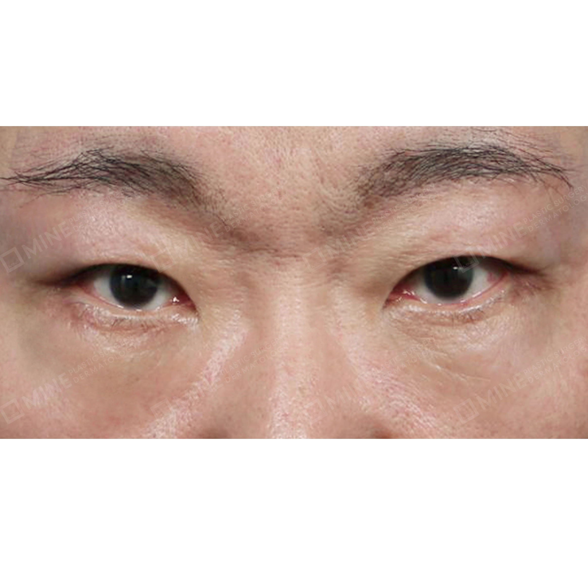 눈썹하거상 + 하안검 + 눈위지방제거-전후-후