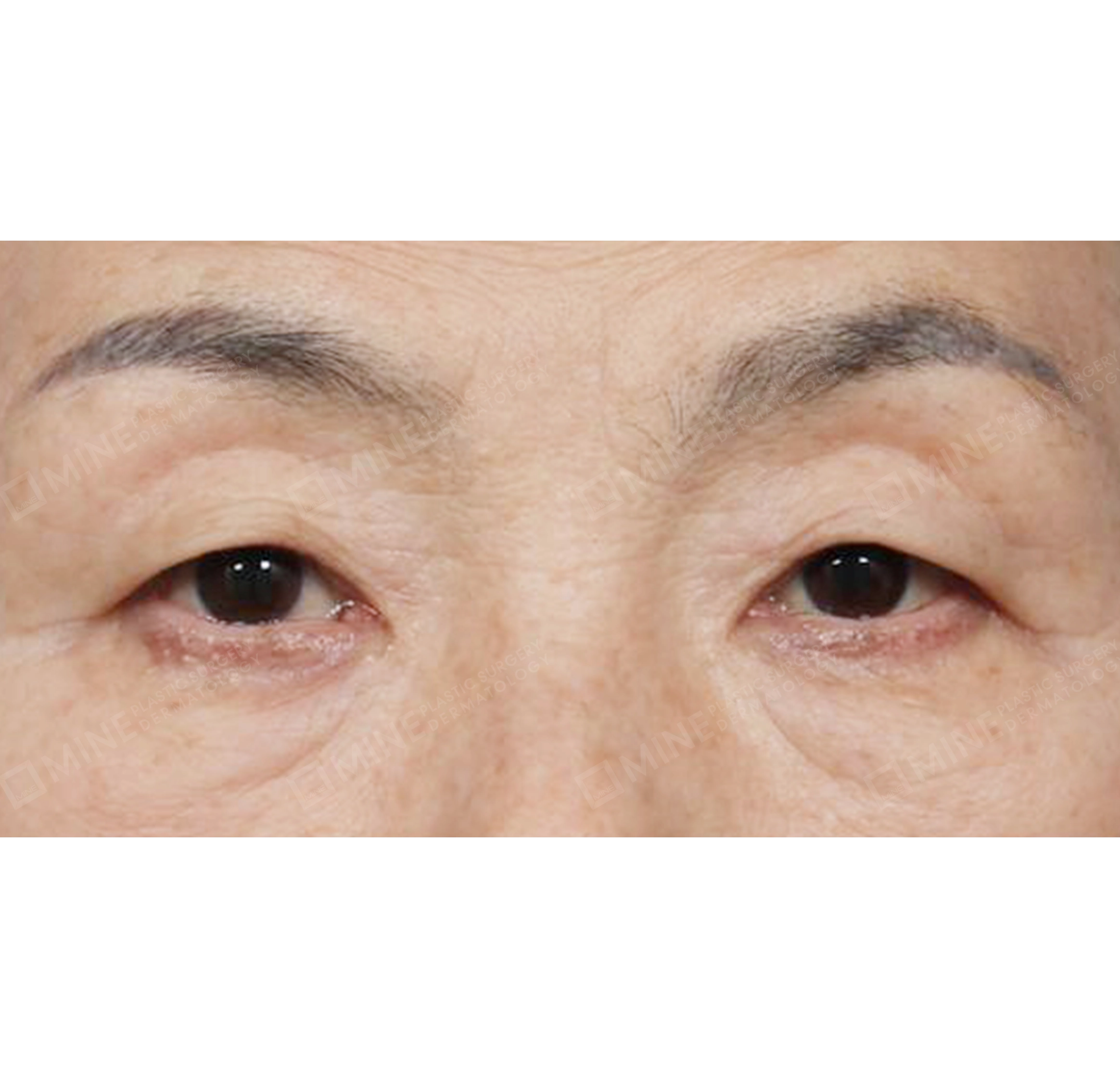 상안검 + 하안검 + 눈썹하거상-전후-전