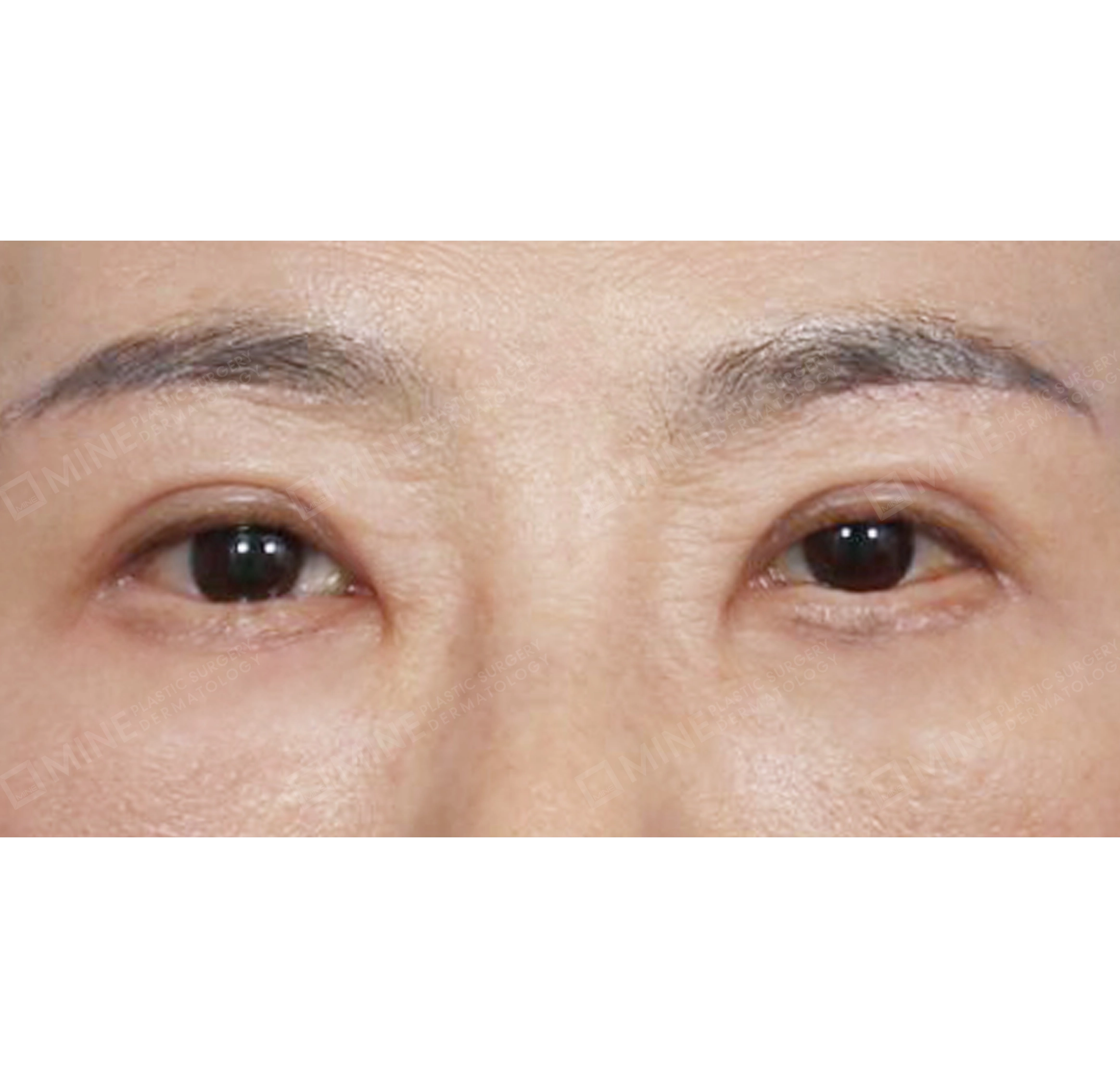 상안검 + 하안검 + 눈썹하거상-전후-후