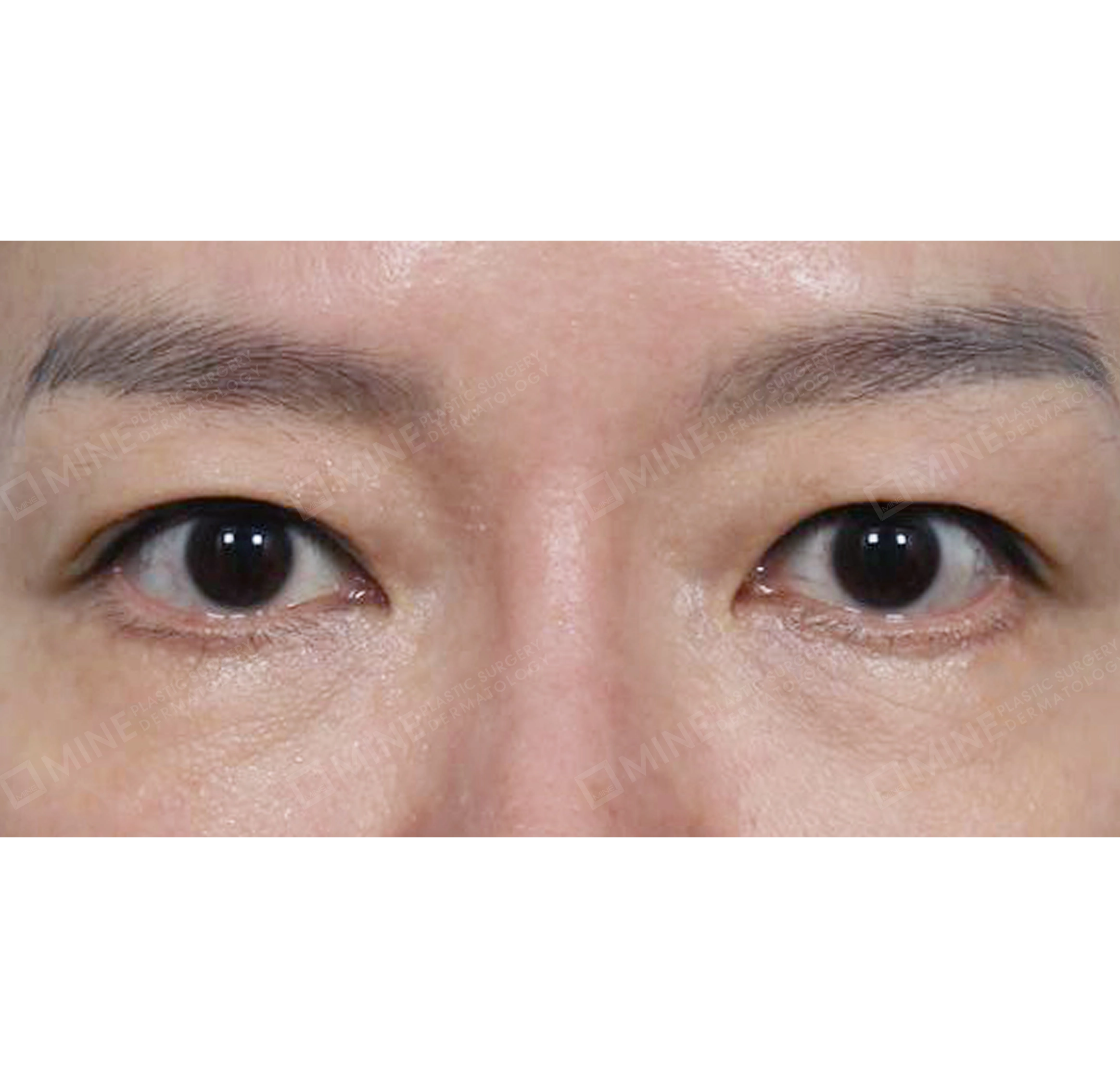 눈썹하거상 + 하안검재수술-전후-전